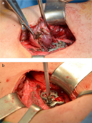 Imágenes intraoperatorias: A) Pared posterior del divertículo esofágico totalmente incluida en el espesor de la placa metálica espinal; B) Retirada de la prótesis de artrodesis cervical.