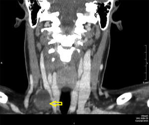 Tomografía computarizada cervical que muestra un nódulo hipodenso posterior al músculo esternocleidomastoideo.