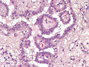 Imagen microscópica. Carcinoma papilar ectópico. (Hematoxilina-eosina ×100).