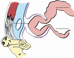 Imagen esquemática del fenómeno de reducción en masa: el asa de intestino delgado queda incarcerada en el saco herniario situado en el espacio preperitoneal.