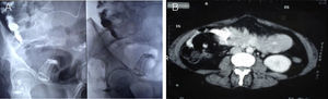 A. Fluoroscopia que evidencia la banda gástrica al nivel de la fosa iliaca derecha. B. Corte transversal de la TC de abdomen y pelvis que muestra la banda gástrica dentro de la luz intestinal.
