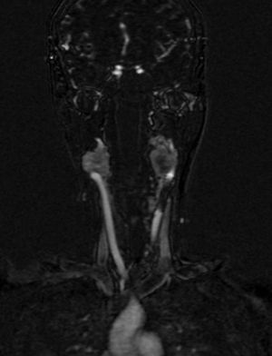 Resonancia magnética que muestra PG carotídeo izquierdo de 3,5cm con extensión a la base del cráneo y PG carotídeo derecho de 1,5cm.