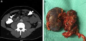 a) Imagen de la tomografía abdominal computarizada preoperatoria en la que se observa una masa retroperitoneal alojada en espacio infrarrenal izquierdo (flecha), que contacta íntimamente con la mitad de la circunferencia de la aorta. b) Pieza quirúrgica en la que se identifica la exéresis en bloque de la tumoración (4×4×11cm) junto al riñón izquierdo.