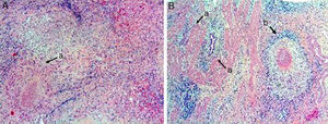 A) Parénquima hepático con granulomas constituidos por células epitelioides y linfocitos, con centros de necrosis caseosa y abscesiﬁcación (a) (hematoxilina-eosina5×). B) Pared de vesícula biliar con tejido ﬁbroconectivo que muestra invaginaciones del epitelio de superﬁcie, conformando senos de Rokitansky-Aschoff (a). Granuloma compuesto por células epitelioides, con células gigantes multinucleadas tipo Langhans, linfocitos y centros con necrosis caseosa (b) (hematoxilina-eosina5×).