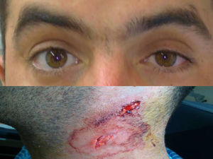 Imagen superior: anisocoria con miosis del ojo izquierdo y ptosis ipsilateral. Imagen inferior: lesiones cervicales incisocontusas.