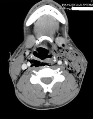 Imagen transversal del angio-TC cervical. Enfisema subcutáneo, sobre todo a nivel izquierdo que diseca hasta mediastino, con posible lesión puntiforme del seno piriforme izquierdo, no se objetivan lesiones de vasos cervicales, ni extravasación de contraste oral, ni hematomas, ni otras alteraciones.
