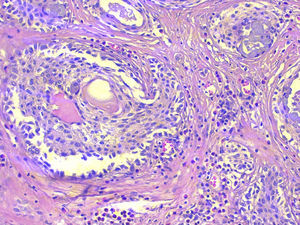 Carcinoma mucoepidermoide esclerosante con eosinofilia sobre tiroiditis de Hashimoto. Visión microscópica donde se aprecia el patrón escamoide de los nidos tumorales, la presencia de células mucosas, el estroma fibroso muy colagenizado y el infiltrado linfocítico con numerosos eosinófilos. Hematoxilina-eosina (x 200).