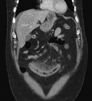 Imagen de tomografía computarizada. Se aprecia líquido libre, congestión de asa de intestino delgado y rarefacción de grasa mesentérica.