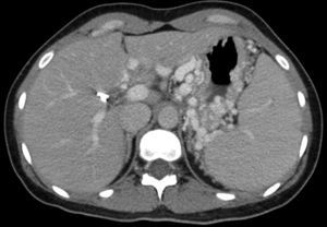 Tomografía axial computarizada que muestra una esplenomegalia de 17cm, varices gástricas y en el ligamento gastrohepático.