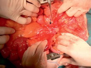 Rotación de 270° del paquete intestinal por paso retrovascular de la primera asa yeyunal. Varices en el borde mesentérico del íleon terminal.