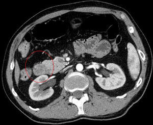 TC axial en fase arterial. Tumoración heterogénea con áreas de densidad grasa en la segunda porción duodenal.