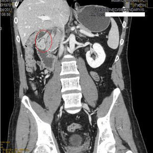 TC coronal en fase portal. La tumoración pediculada nace de la primera porción duodenal.