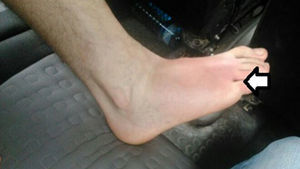 Primer día: pápula violácea entre el 4.° y el 5.° dedo del pie (donde muestra la flecha), con celulitis en el dorso del pie.