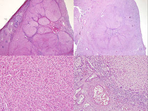 Histología: tumor hepatocelular con bandas fibrosas unidas en una gran cicatriz central (imágenes superiores izquierda y derecha). Los hepatocitos no muestran atipia (imagen inferior izquierda). La cicatriz central muestra grandes vasos con paredes anormalmente engrosadas (imagen inferior derecha).