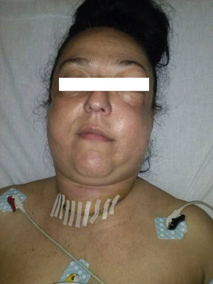 Fotografía de la paciente tras episodio brusco de tos, con inflamación de cara y cuello progresiva.