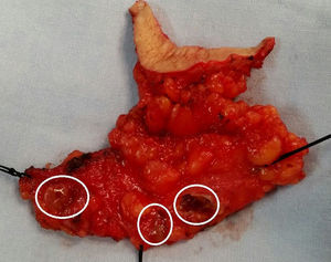 Pieza quirúrgica en la que se identifica tejido celular subcutáneo con 3 quistes coloides (círculos).