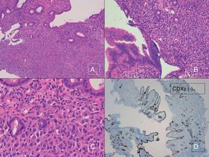 Detalle microscópico con hematoxilina y eosina de la metástasis del carcinoma lobulillar mamario, integrada por células con variable pleomorfismo y hábito en anillo de sello (A-C) (H&E 10× [A], H&E 20× [B] y H&E 40× [C]), y células tumorales metastásicas con inmunoexpresión negativa para CDX2 (marcador de organoespecificidad gastrointestinal) en el componente neoplásico (véase positividad en el epitelio de revestimiento intestinal y glandular normal) (D) (CDX2 4×).
