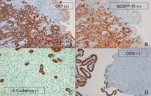 Células tumorales metastásicas con inmunoexpresión positiva para CK7 (A) (CK7 10×) y GCDFP15 (B) (GCDFP15 10×), e inmunoexpresión negativa para E-cadherina (C) (E-cadherina 20×) y CK20 (D) (CK20 10×).