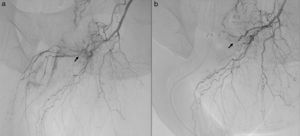 a) Angiografía que muestra el paso de contraste por la fístula arteriovenosa; b) angiografía que muestra la obliteración de la fístula arteriovenosa tras la embolización.