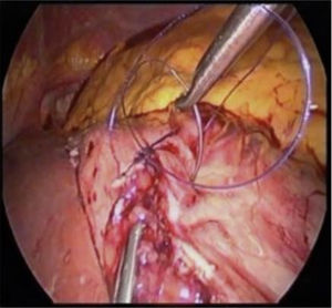 Uso de la sutura barbada en cirugía gástrica laparoscópica.