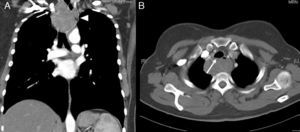 Tomografía computarizada cervicotorácica en la que se observa (A) la tumoración esofágica que comprime a estructuras vasculares (flecha) y (B) a la tráquea (flecha).