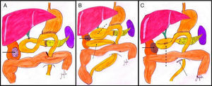 A) Implante tumoral anterior a riñón derecho (flecha continua); B) Fibrosis a nivel de polo renal derecho (flecha continua), que ocasiona una obstrucción del asa aferente (flecha discontinua) y hernia interna de asas de yeyuno a través del orificio transmesocólico (flecha punteada); C) Fibrosis a nivel de polo renal derecho (flecha continua), anastomosis yeyuno-yeyunal latero-lateral del asa aferente (flecha discontinua), y reducción de asas yeyuno con cierre del ojal transmesocólico (flecha punteada).