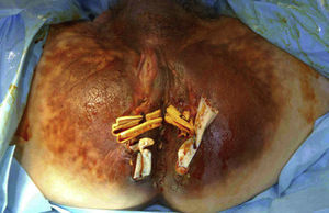 Sepsis perianal secundaria a enfermedad de Crohn.