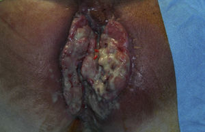 Carcinoma escamoso de ano desarrollado sobre enfermedad de Crohn perianal.