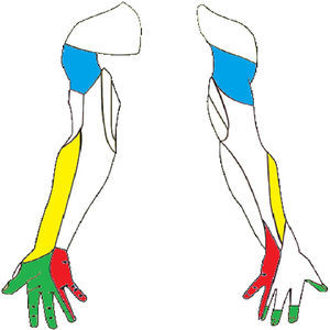 Inervación sensitiva del miembro superior. Se han marcado los troncos nerviosos con lesiones referidas en la literatura. Nervio musculocutáneo (borde lateral del antebrazo), nervio axilar (área del hombro), nervio mediano (palmar lateral) y nervio cubital (palmar y dorsal medial).