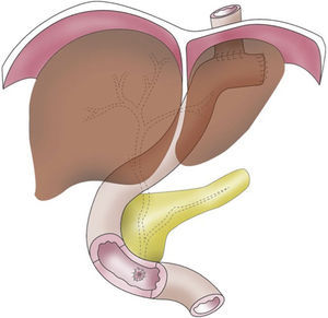 Esquema de la gastroduodenectomía total con preservación pancreática.