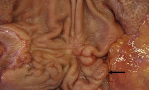 Imagen de la pieza quirúrgica en la que se observa un adenoma tubular pilórico (flecha). La biopsia demostró carcinoma in situ.