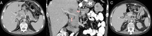 TAC plano axial (A) y coronal (B) con CIV. Conglomerado adenopático, mal definido, en hilio hepático, que rodea la arteria hepática (flechas blancas en A) y la vena porta (flechas rojas en B). Área central hipodensa que corresponde a necrosis (asterisco en A). TAC plano axial con CIV (C). Múltiples adenopatías en hilio hepático, zona interaortocava y lateroaróticas izquierdas (flechas).