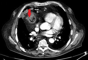 Tomografía computarizada del tórax, que muestra la imagen de la neoplasia (flechas) en la coloplastia.