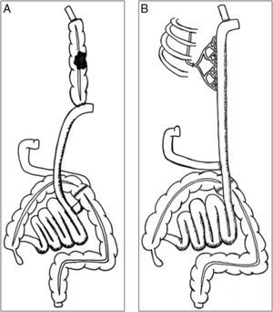 Dibujo que muestra: A) la situación previa del paciente con el adenocarcinoma surgido en el segmento de colon interpuesto, y B) la reconstrucción, tras la exéresis del colon, mediante una interposición de un segmento largo de yeyuno con anastomosis de la vena y arteria yeyunales a la vena y arteria mamaria interna (supercharged).