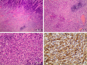 Estudio histológico e enmubohistoquímico; CD34+ y proteincinasa para linfoma anaplásico +.
