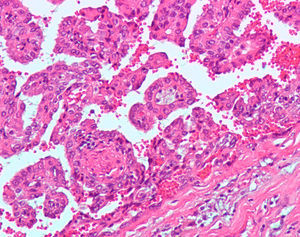 Metástasis de carcinoma renal papilar CD10+,con abundantes áreas hemorrágicas y neovascularización.