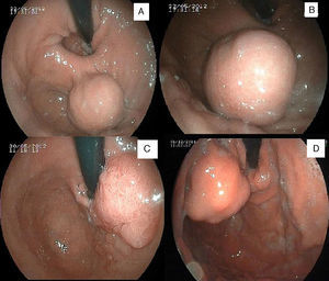 A y B) Endoscopia digestiva alta (paciente 1): lesión submucosa en fundus gástrico compatible con GIST. C) EDA (paciente 2): pólipo de predominio exofítico en región subcardial. D) EDA (paciente 3): lesión subcardial de probable origen mucoso.