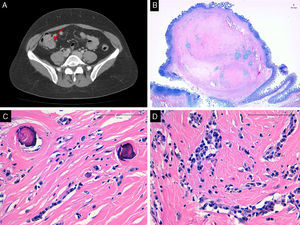 A) Imagen de la TAC de abdomen en la que se observa lesión ileal con calcificaciones. B) Tumor bien delimitado situado en la submucosa. C) La neoplasia muestra calcificaciones tipo psammoma (HE 40X). D) Se observa estroma colágeno denso e infiltrado inflamatorio linfoplasmacitario (HE 40X).