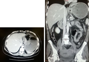 Tomografía computarizada abdominal en urgencias. Hernia gástrica.
