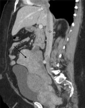 TC con gran tumoración uterina (flecha) y crecimiento tumoral a venas ilíacas, ováricas y cava (estrella), hasta aurícula derecha.