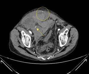 Imagen de hematoma espontáneo del músculo recto anterior derecho de tipo III de Berna diagnosticado mediante angio-TC (flecha: arteria epigástrica inferior) (Círculo: hemorragia activa).