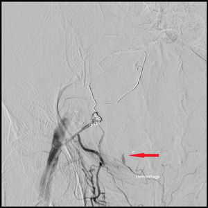 Arteriografía que muestra hemorragia procedente de la arteria epigástrica inferior derecha (flecha).