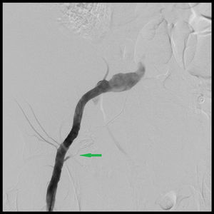 Arteriografía después de la embolización con microcoils de la arteria epigástrica inferior (flecha).