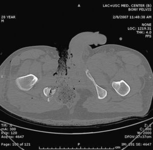 Tomografía axial computarizada del paciente de la figura 2, donde se observa una fractura de la rama pélvica derecha asociada a la lesión perineal.