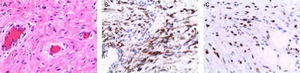A) Angiomixoma agresivo (H&E ×200): células tumorales con núcleos ovalados uniformes sin atipia, en un estroma edematoso con fibras de colágeno y abundantes vasos dilatados. B) Positividad inmunohistoquímica de las células para desmina. C) Positividad inmunohistoquímica de las células para receptores de estrógenos.