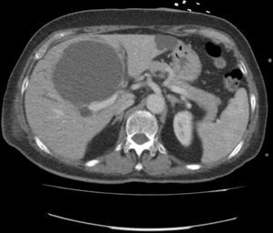 Tomografía computarizada abdominal: gran LOE hepática de aspecto quístico de 12,1×9,4×9,3cm en lóbulo hepático derecho, a nivel de los segmentos IV y V.