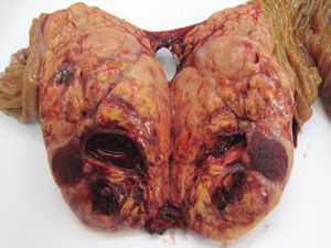 Corte macroscópico de un tumor neuroendocrino G1 (OMS, 2010) localizado en cabeza de páncreas.