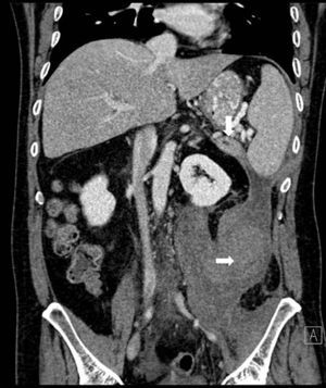 TAC abdominopévica: extensas colecciones retroperitoneales que se originan por la fístula en la cola pancreática desconectada del resto de la glándula (flecha blanca).