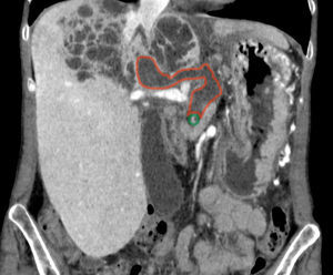 Corte coronal de la TAC. Fístula comunicando conducto pancreático con lesión quística hepática, marcado su perímetro. Litiasis, intrapancreática marcada con círculo.