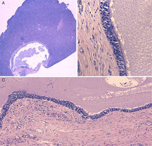 A) Imagen microscópica del QHC rodeado por parénquima hepático normal (hematoxilina-eosina). B) Detalle de la pared del quiste mostrando el epitelio ciliar seudoestratificado y la capa de músculo liso subyacente (hematoxilina-eosina ×400). C) Detalle de la pared del quiste mostrando el epitelio ciliar seudoestratificado y las capas subyacentes características (hematoxilina-eosina ×100).